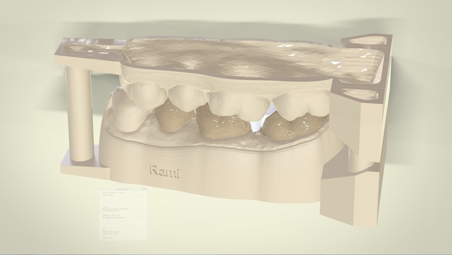 ​Digital Dental Inlay Bridge Model for 3D Printing