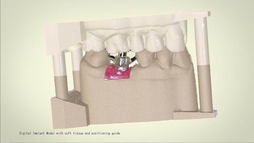 Digital Dental Implant Model with Positioning Guide