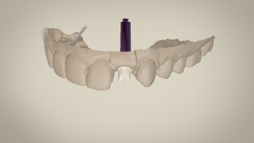 Digital Custom Dental Abutment