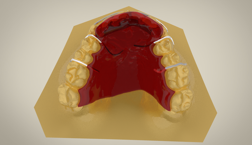Digital Activator Splint (Orthodontic Appliance)
