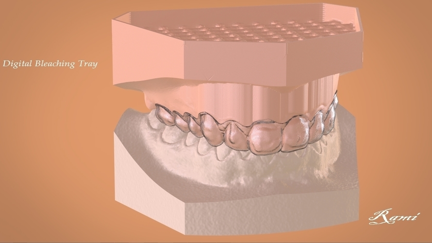Digital Dental Bleaching Tray