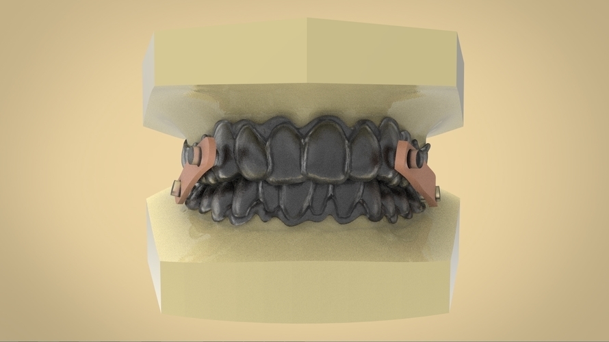 elastic mandibular advancement device