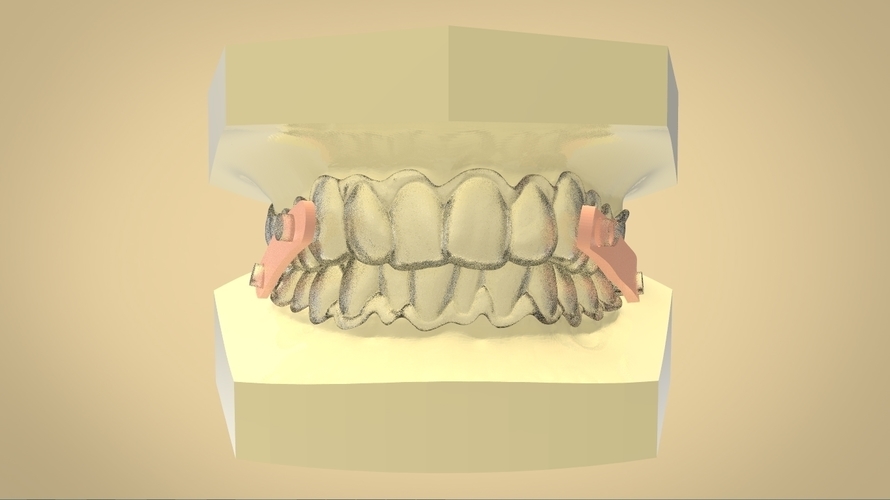 elastic mandibular advancement device