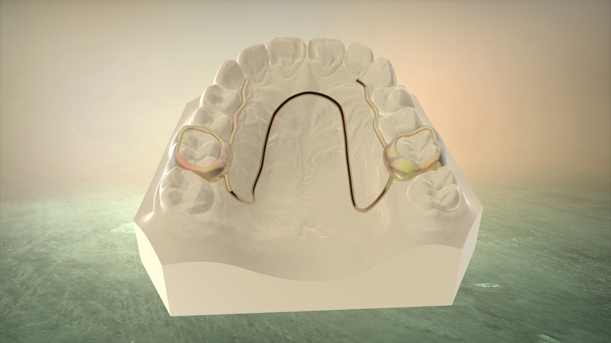 3D Printed Digital W Arch Appliance (Orthodontic Appliance) by LabMagic ...