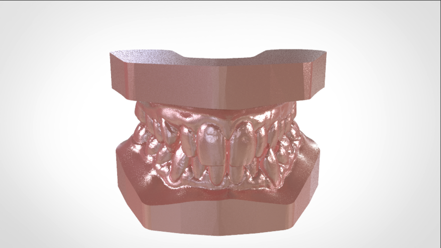 ​Digital Study Orthodontic Models with Archman Virtual Bases