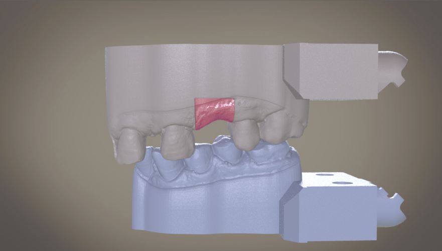 Digital Implant Model with Soft Tissue