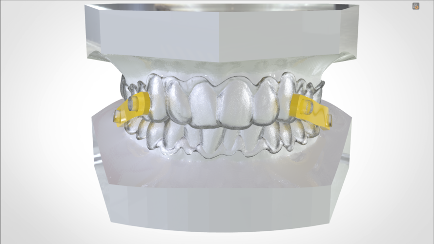 Digital Elastic Mandibular Advancement Appliance