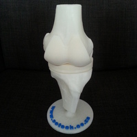 Artificial Knee Prosthesis - Thumbnail 2