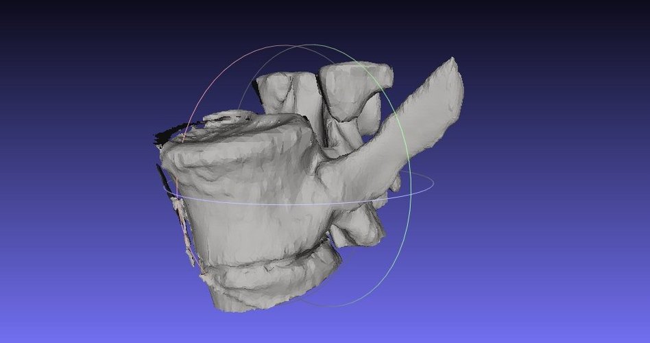 Vertebrae (MRI)