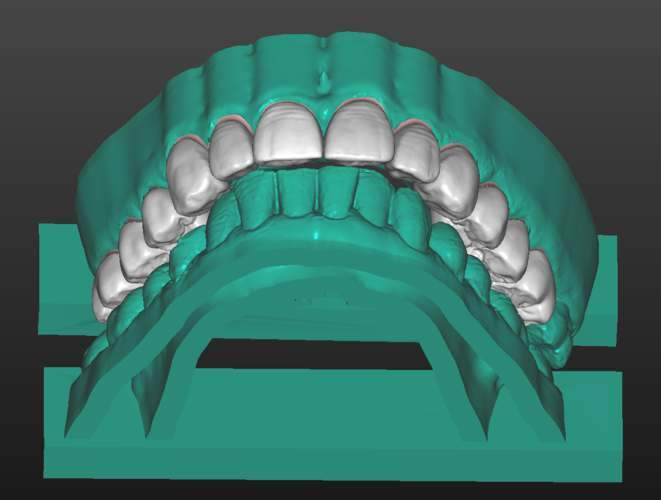 Patient 001 - Full Upper Restoration 3D Print 387027