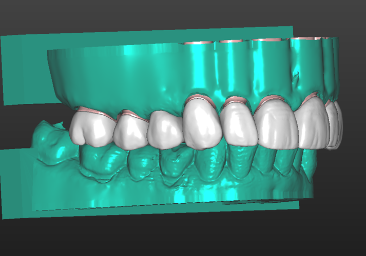 Patient 001 - Full Upper Restoration 3D Print 387029