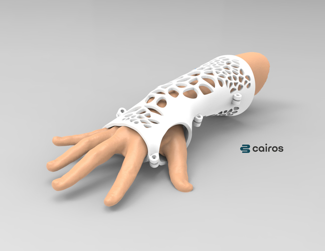 ARM SPLINT - ARM CAST - ARM PLASTER - MEDICAL 3D Print 395079