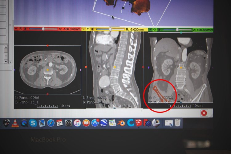 Hip Bone Segment (MRI) 3D Print 44399