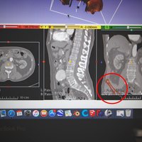 Hip Bone Segment (MRI) - Thumbnail 2