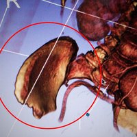 Hip Bone Segment (MRI) - Thumbnail 3