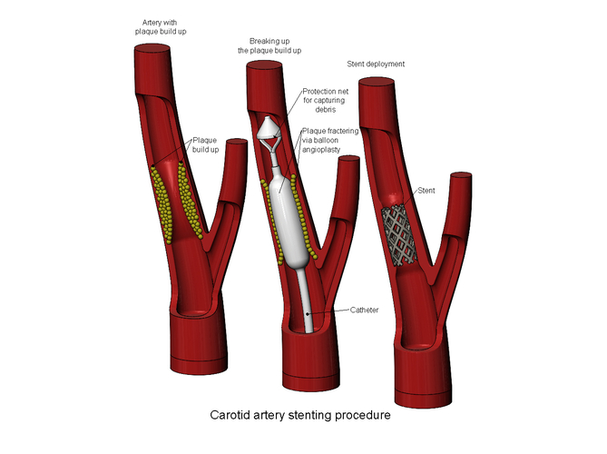 3d printable Carotid artery stenting procedure diorama  3D Print 472809