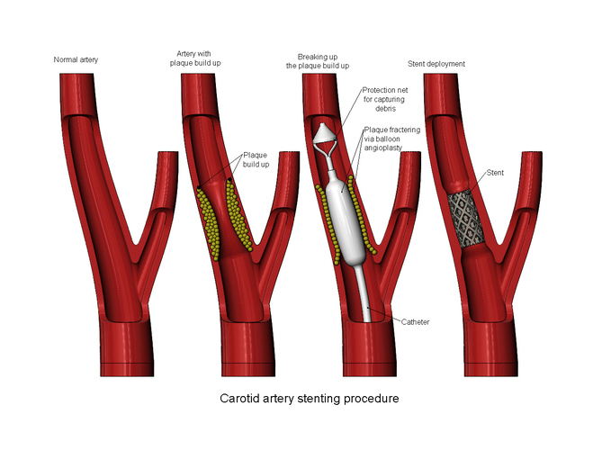 3d printable Carotid artery stenting procedure diorama  3D Print 472810