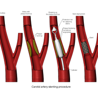 Small 3d printable Carotid artery stenting procedure diorama  3D Printing 472810