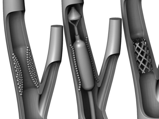 3d printable Carotid artery stenting procedure diorama  3D Print 472816