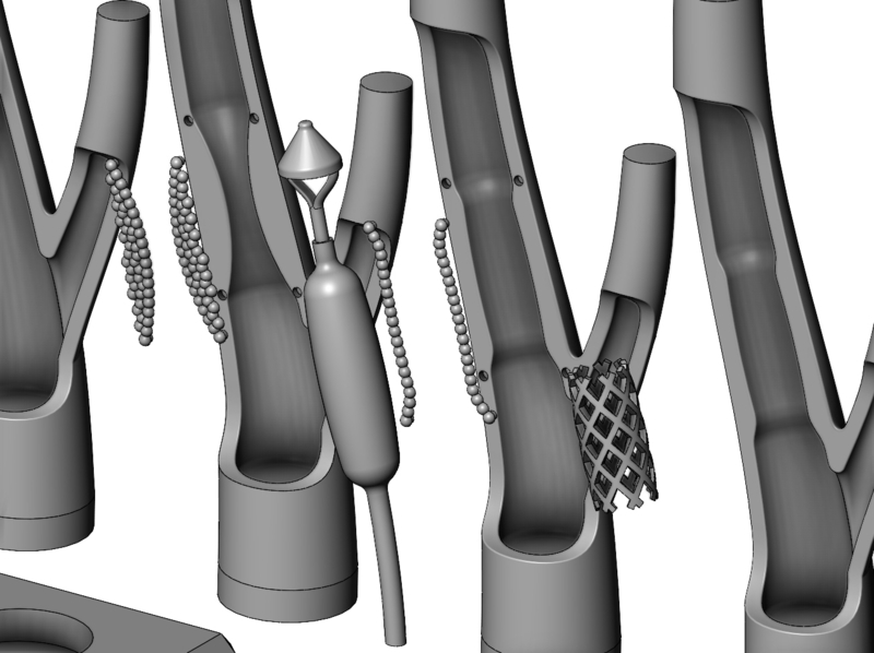 3d printable Carotid artery stenting procedure diorama - Pinshape