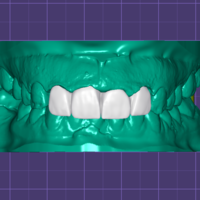 4-Unit Dental Bridge Design - Thumbnail 3
