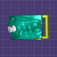 4-Unit Dental Bridge Design - Thumbnail 4
