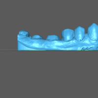 2-Unit Dental Bridge Design - Thumbnail 3