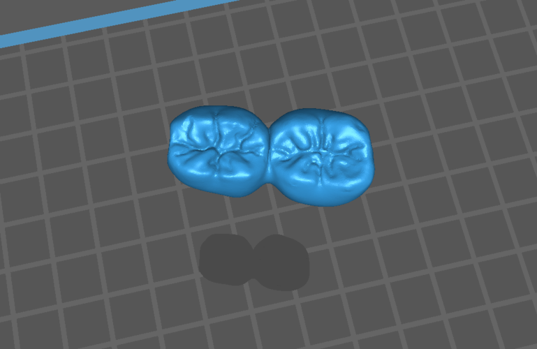 2-Unit Dental Bridge Design