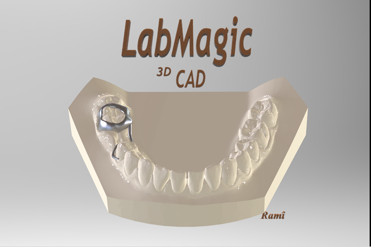 3D Printed Digital Space Maintainer Appliance (Dental) by LabMagic 3D ...
