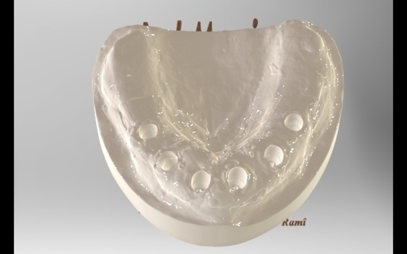 Dental Implant Model