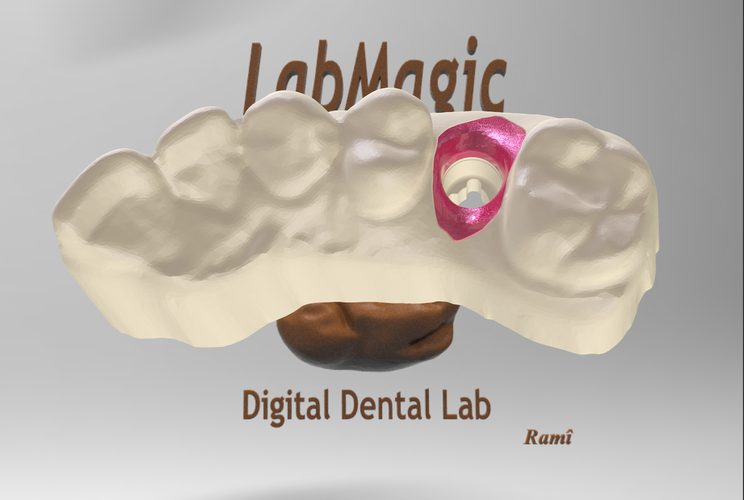 Digital Dental Implant Model with Soft Tissue