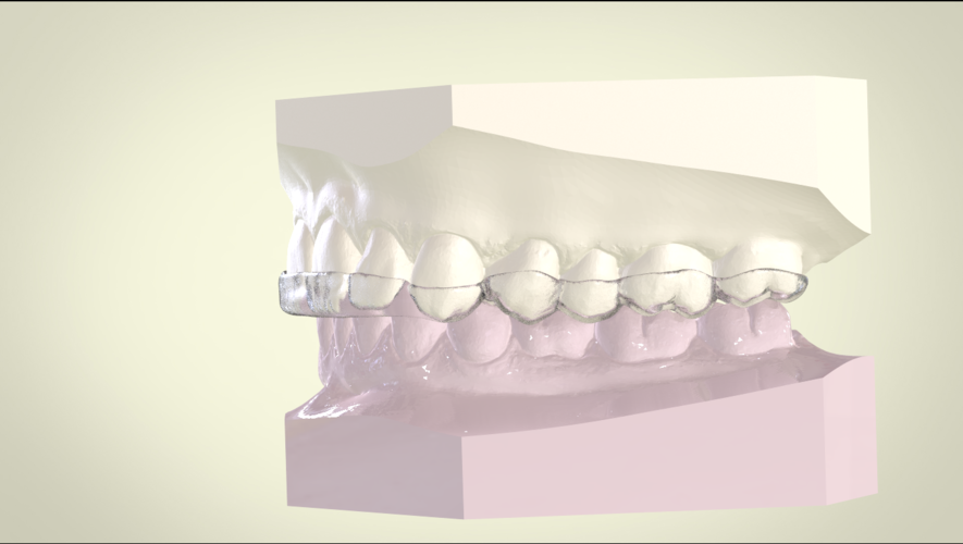 3D Printed Digital Spear Deprogrammer Splint By LabMagic 3D CAD Pinshape