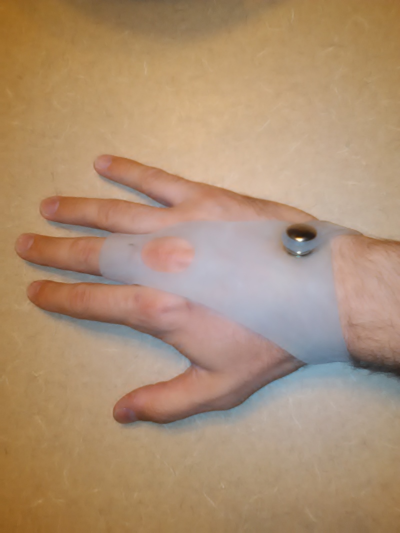 Finger Flexion Limiter