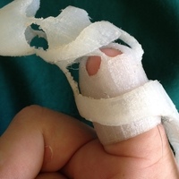 prosthetic finger - Thumbnail 2