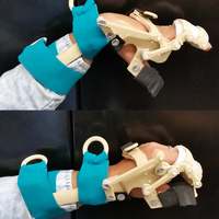 3D-Printed Wrist-Driven Orthosis (WDO) - Thumbnail 4